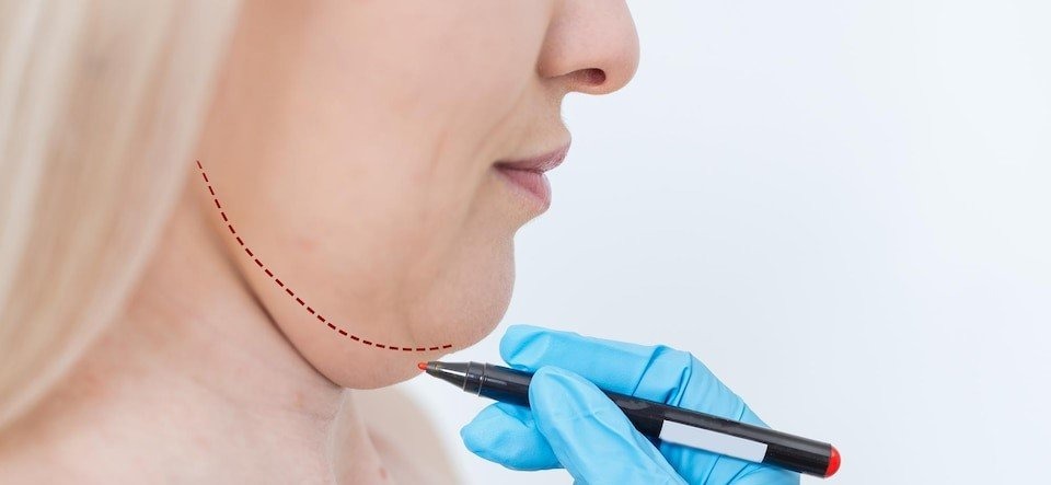 Can You Achieve a Defined Jawline with Double Chin Removal in Dubai